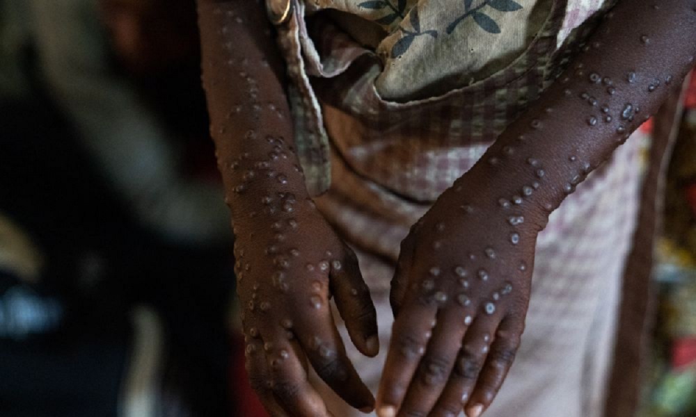 Brasil se aproxima da marca de 90 casos confirmados de MPOX